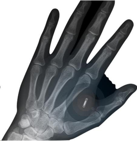 Xray of a hand