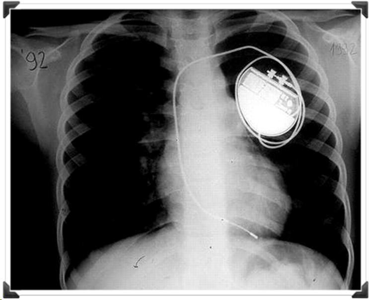 Picture of pacemaker